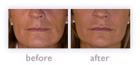 Juv&eacute;derm before and after