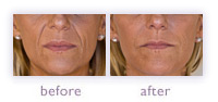 Juv&eacute;derm before and after