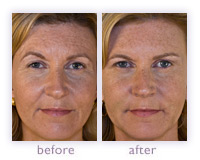 Juv&eacute;derm before and after