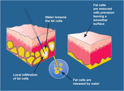 Liposoft how does it work diagram