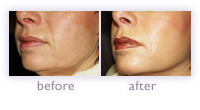 Sculptra, Collagen Stimulating Therapy