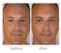 Men's wrinkle treatment before and after