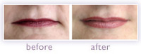 Lip Rejuvenation before and after