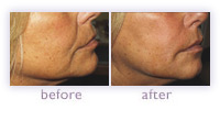 Sculptra before and after