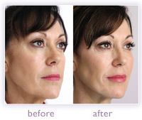 Lip Enhancement before and after