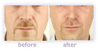 Men's facial rejuvenation before and after