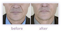 Men's facial wrinkle treatment before and after