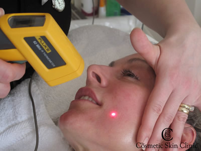 Suzzane Dando - Pelleve Treatment