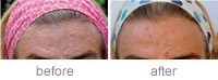 Acne scarring. Improvement after two Genuine Dermaroller� procedures