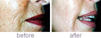 Ageing & sun damaged skin/lines & wrinkles Improvement 3 months after one Genuine Dermaroller� procedure