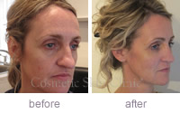 Mandy profile Juvederm before and after