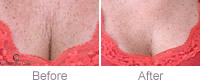 D�colletage treatment
