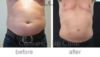 CoolSculpting abdomen treatment
