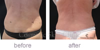 CoolSculpting female treatment