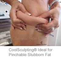 CoolSculpting - ideal for pinchable grabable stubborn fat