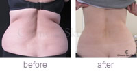 Kate Battrick CoolSculpting abdomen & flanks before and after