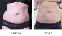 CoolSculpting abdomen and flanks before and after