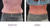 CoolSculpting muffin top treatment