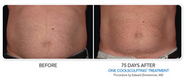 Non-surgical fat reduction before and after