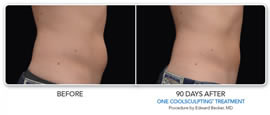 Fat reduction before and after