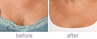 Decolletage treatment