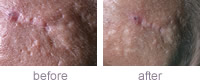 Acne scaring improvement after one Dermaroller procedure