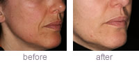 Dermaroller MS4 before and after