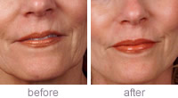 Dermaroller MS4 performed on top lip during face lift