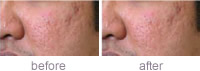 Efficacy and safety in pigmented skin. Improvement of acne scars after four Genuine Dermaroller� procedures