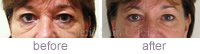 Jenny Welch - Tear Trough Before & after