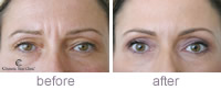 Glabella treatment before and after