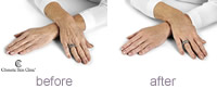 Hand treatment