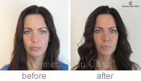 Juvederm Non-surgical face lift