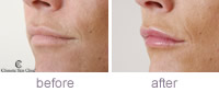 Katie Lip Enhacement