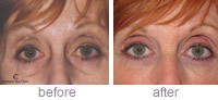Tear Trough before and after