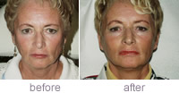 Liquid face lift before & after