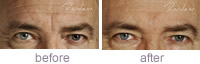 Glabella treatment for men