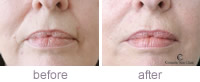 Nasolabial folds treatment before and after