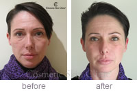 Restylane azzalure lower face lift before & after