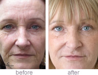 Angela Brown - Non-surgical face lift