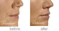 Lip treatment before and after