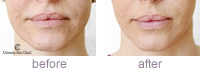 Emily - Restylane Lip Refresh before and after