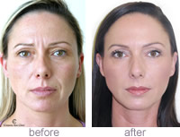 Rachel Buckinghamshire - BOTOX muscle relaxing