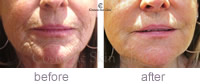 Restylane Skinbooster before & after