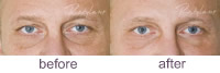 Tear Trough treatment - Restylane®