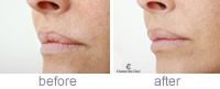 Emily Cash - Restylane