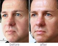 Phil - Restylane&reg; wrinkle treatment
