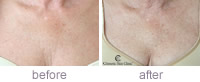 Sally Restylane decolletage treatment before and after