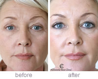 Restylane full face treatment before and after