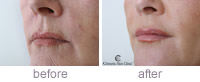Lip treatment before and after